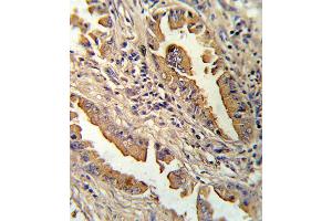Formalin-fixed and paraffin-embedded human lung carcinoma reacted with IL8 Antibody , which was peroxidase-conjugated to the secondary antibody, followed by DAB staining.