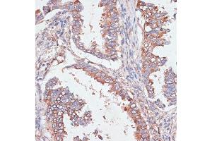 Immunohistochemistry of paraffin-embedded human lung cancer using G antibody  at dilution of 1:100 (40x lens). (GAB1 抗体  (AA 1-150))