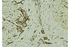 ABIN6273229 at 1/100 staining Human breast cancer tissue by IHC-P. (DOM3Z 抗体  (Internal Region))