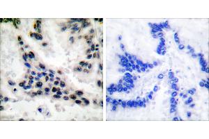 Peptide - +Immunohistochemical analysis of paraffin-embedded human lung carcinoma tissue using HDAC1 antibody (#C0221). (HDAC1 抗体)
