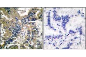 Immunohistochemistry analysis of paraffin-embedded human lung carcinoma tissue, using IL-1 beta (Cleaved-Asp210) Antibody. (IL-1 beta 抗体  (Cleaved-Asp210))