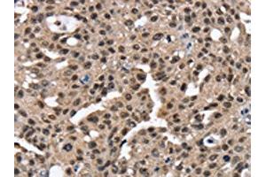 The image on the left is immunohistochemistry of paraffin-embedded Human breast cancer tissue using ABIN7130904(RNF40 Antibody) at dilution 1/25, on the right is treated with fusion protein. (RNF4 抗体)