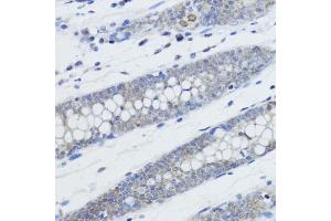 Immunohistochemistry of paraffin-embedded human colon using MonoMethyl-Histone H4-K20 antibody (ABIN3016044, ABIN3016045, ABIN3016046, ABIN1680258 and ABIN6219531) at dilution of 1:200 (40x lens).