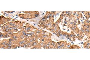 Immunohistochemistry of paraffin-embedded Human liver cancer tissue using ATP5C1 Polyclonal Antibody at dilution of 1:55(x200) (ATP5C1 抗体)