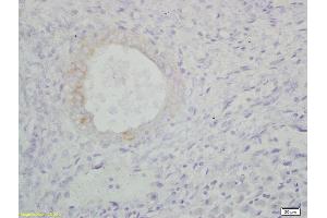 Formalin-fixed and paraffin embedded human endometrium carcinoma labeled with Anti-100-A9/MRP14/CFAG/Calgranulin B Polyclonal Antibody, Unconjugated (ABIN749288) at 1:200, followed by conjugation to the secondary antibody and DAB staining (S100A9 抗体  (AA 51-114))
