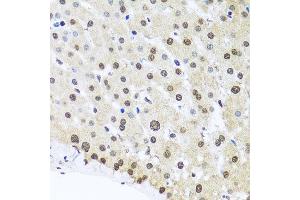 Immunohistochemistry of paraffin-embedded human liver injury using FUBP1 antibody at dilution of 1:100 (x40 lens).