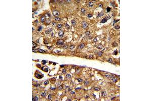 Formalin-fixed and paraffin-embedded human hepatocarcinoma reacted with MDH1 Antibody (C-term), which was peroxidase-conjugated to the secondary antibody, followed by DAB staining. (MDH1 抗体  (C-Term))