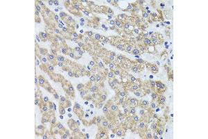 Immunohistochemistry of paraffin-embedded human liver injury using ACP1 antibody at dilution of 1:100 (x40 lens). (ACP1 抗体)