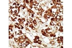 IHC analysis of FFPE human hepatocarcinoma tissue stained with the ZAK antibody (ZAK 抗体  (AA 271-300))