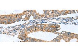 Immunohistochemistry of paraffin-embedded Human colorectal cancer tissue using CLEC1B Polyclonal Antibody at dilution of 1:60(x200)