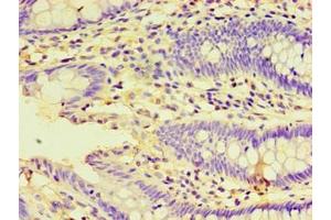 Immunohistochemistry of paraffin-embedded human colon cancer using ABIN7155929 at dilution of 1:100 (HSPBAP1 抗体  (AA 1-488))
