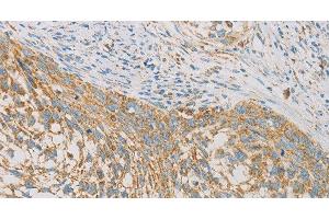Immunohistochemistry of paraffin-embedded Human cervical cancer tissue using REN Polyclonal Antibody at dilution 1:40 (Renin 抗体)