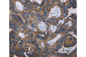 Immunohistochemistry of Human colon cancer using F11R Polyclonal Antibody at dilution of 1:60 (F11R 抗体)