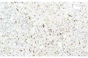 Immunohistochemistry of paraffin-embedded Human breast carcinoma tissue using JAK1 Monoclonal Antibody at dilution of 1:200. (JAK1 抗体)