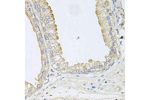 Immunohistochemistry of paraffin-embedded human prostate using ANKH antibody (ABIN6003613) at dilution of 1/100 (40x lens). (ANKH 抗体)
