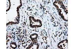 Immunohistochemical staining of paraffin-embedded Adenocarcinoma of ovary tissue using anti-LTA4H mouse monoclonal antibody. (LTA4H 抗体)