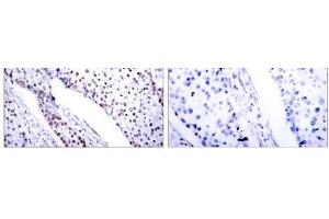 Immunohistochemical analysis of paraffin-embedded human breast carcinoma tissue using STAT3 (Ab-705) antibody (E021045). (STAT3 抗体)