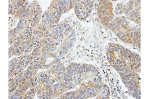 IHC-P Image Immunohistochemical analysis of paraffin-embedded human gastric cancer, using RIP2, antibody at 1:100 dilution. (RIPK2 抗体)
