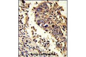 Formalin-fixed and paraffin-embedded human lung carcinoma reacted with LUC7L Antibody (C-term), which was peroxidase-conjugated to the secondary antibody, followed by DAB staining. (LUC7L 抗体  (C-Term))