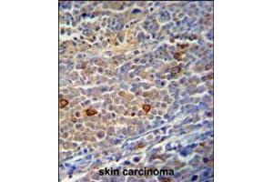 C9orf156 Antibody immunohistochemistry analysis in formalin fixed and paraffin embedded human skin carcinoma followed by peroxidase conjugation of the secondary antibody and DAB staining. (C9orf156 抗体  (C-Term))