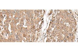 Immunohistochemistry of paraffin-embedded Human liver cancer tissue using MAGOHB Polyclonal Antibody at dilution of 1:70(x200) (Mago Nashi Homolog 2 抗体)