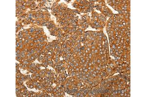 Immunohistochemistry of Human lung cancer using SFRP1 Polyclonal Antibody at dilution of 1:80 (SFRP1 抗体)