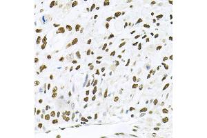 Immunohistochemistry of paraffin-embedded human lung cancer using MAPK8 antibody (ABIN5970116) at dilution of 1/100 (40x lens).