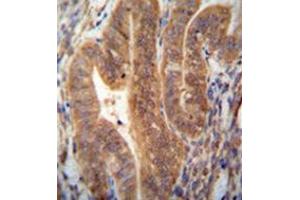 Immunohistochemistry analysis in formalin fixed and paraffin embedded human uterus tissue reacted with KIAA1644 antibody (N-term) followed which was peroxidase conjugated to the secondary antibody and followed by DAB staining. (SHISAL1/KIAA1644 抗体  (N-Term))