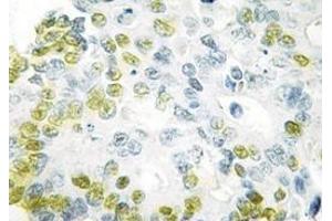 Immunohistochemistry analyzes of C/EBP-α antibody in paraffin-embedded human colon carcinoma tissue. (CEBPA 抗体)