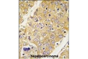 Formalin-fixed and paraffin-embedded human hepatocarcinoma tissue reacted with Dtnbp1 Antibody (C-term) (ABIN389170 and ABIN2839336) , which was peroxidase-conjugated to the secondary antibody, followed by DAB staining. (DTNBP1 抗体  (C-Term))