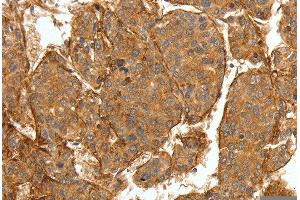 Immunohistochemistry of Human breast cancer using COL4A1 Polyclonal Antibody at dilution of 1:30