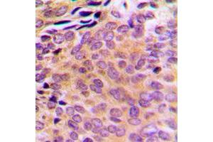 Immunohistochemical analysis of AKR1CL2 staining in human breast cancer formalin fixed paraffin embedded tissue section. (AKR1E2 抗体  (Center))