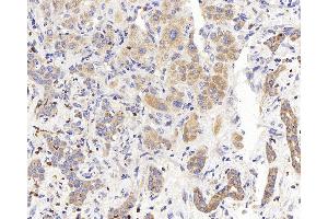 Immunohistochemistry analysis of paraffin-embedded human liver cancer using PERK Polyclonal Antibody at dilution of 1:400. (PERK 抗体)
