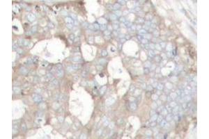 Immunohistochemistry analyzes of Cortactin antibody in paraffin-embedded human prostate carcinoma tissue. (Cortactin 抗体)