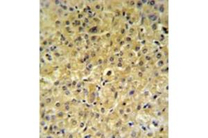 Immunohistochemistry analysis in formalin fixed and paraffin embedded hepatocarcinoma reacted with INSC Antibody (Center) followed by peroxidase conjugation of the secondary antibody and DAB staining.