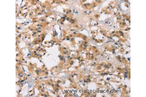 Immunohistochemistry of Human thyroid cancer using MARC1 Polyclonal Antibody at dilution of 1:40 (MOSC1 抗体)