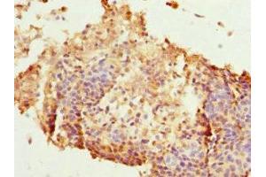 Immunohistochemistry of paraffin-embedded human cervical cancer using ABIN7165626 at dilution of 1:100 (HEXIM1 抗体  (AA 210-359))