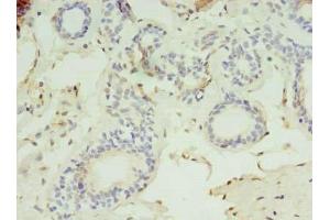 Immunohistochemistry of paraffin-embedded human breast cancer using ABIN7158756 at dilution of 1:100 (LYPLAL1 抗体  (AA 2-237))