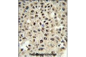 Formalin-fixed and paraffin-embedded human hepatocarcinoma reacted with SSB Antibody (N-term) (ABIN1882133 and ABIN2839422) , which was peroxidase-conjugated to the secondary antibody, followed by DAB staining. (SSB 抗体  (N-Term))