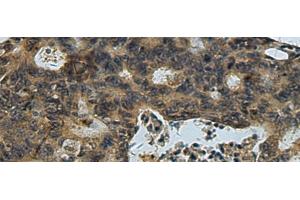 Immunohistochemistry of paraffin-embedded Human colorectal cancer tissue using PLTP Polyclonal Antibody at dilution of 1:60(x200) (PLTP 抗体)