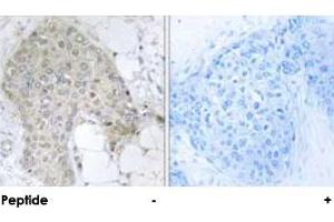 Immunohistochemical analysis of paraffin-embedded human breast carcinoma tissue using PPP1R2 polyclonal antibody . (PPP1R2 抗体  (Ser120, Ser121))