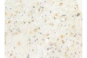 ABIN6264878 and ABIN6272422 at 1/100 staining human astrocytoma by IHC-P. (RTCD1 抗体  (C-Term))