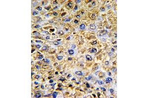 Formalin-fixed and paraffin-embedded human hepatocarcinoma with DCN Antibody , which was peroxidase-conjugated to the secondary antibody, followed by DAB staining. (Decorin 抗体  (AA 122-150))