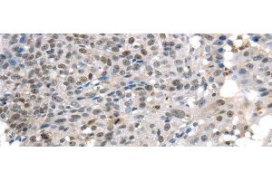 Immunohistochemistry of paraffin-embedded Human breast cancer tissue using KDM5C Polyclonal Antibody at dilution 1:45 (KDM5C 抗体)