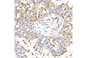 Immunohistochemistry of paraffin-embedded human breast cancer using HINT1 Rabbit mAb (ABIN7267663) at dilution of 1:50 (40x lens). (HINT1 抗体)