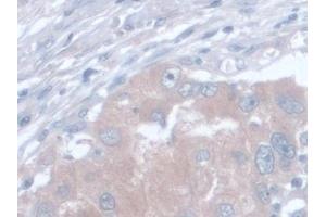 Detection of AST in Human Breast cancer Tissue using Monoclonal Antibody to Aspartate Aminotransferase (AST) (GOT1 抗体  (AA 1-413))