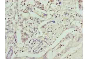 Immunohistochemistry of paraffin-embedded human pancreatic cancer using ABIN7161374 at dilution of 1:100 (GPM6B 抗体  (AA 1-64))