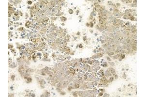 ABIN6259124 and ABIN6275293 at 1/100 staining human melanoma by IHC-P. (NEURL2 抗体  (Internal Region))