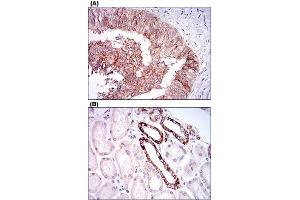 Immunohistochemical staining of human ovarian cancer tissues (A) and kidney tissues (B) with TIE1 monoclonal antibody, clone 8D12D2  at 1:200-1:1000 dilution. (TIE1 抗体  (AA 385-607))