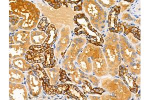 ABIN6258796 and ABIN6275126 at 1/100 staining Human kidney cancer and adjacent normal tissues by IHC-P. (FOLR1 抗体  (Internal Region))
